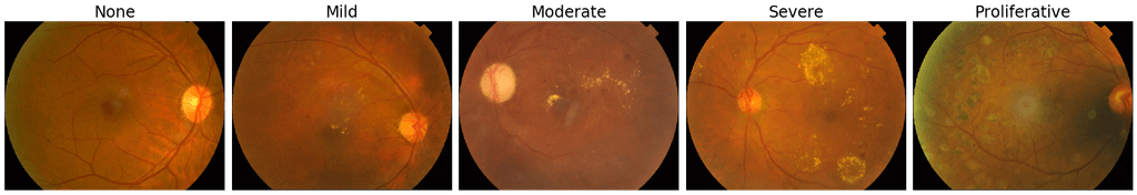 Example images from the APTOS diabetic retinopathy dataset.