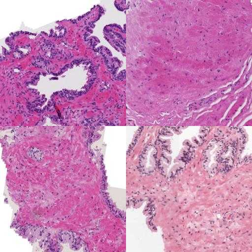 Prostate Cancer Grading